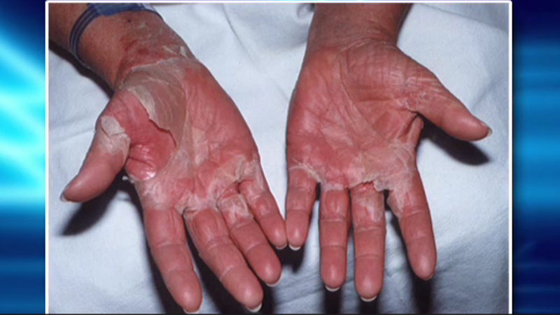 sindrome-shock-toxico