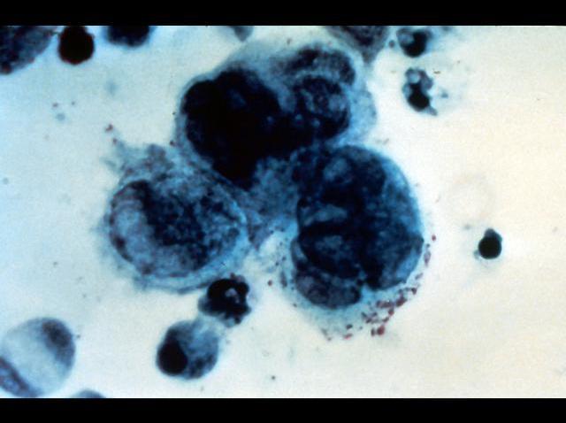 tlmd_04_17herpes