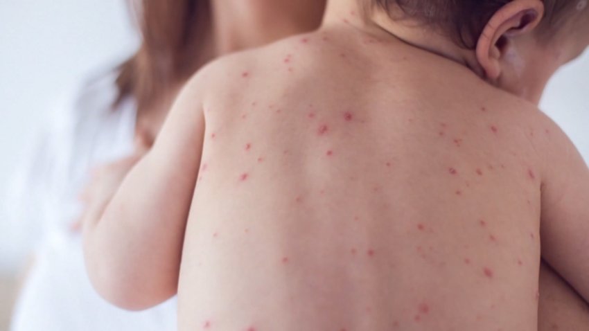Baby with measles rash