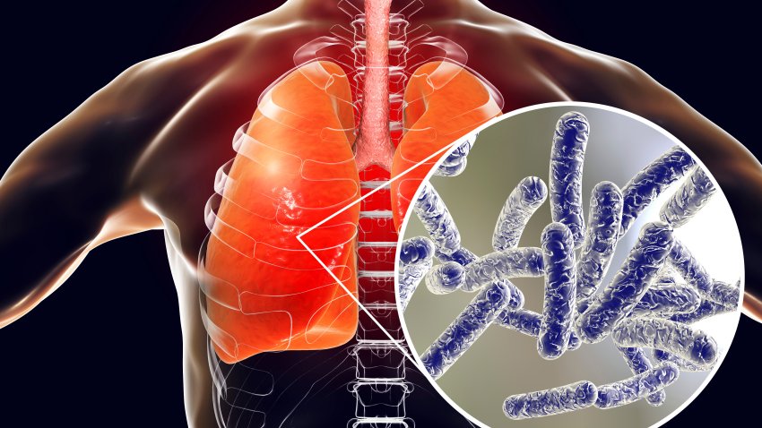 Lo que debes saber de la enfermedad del legionario