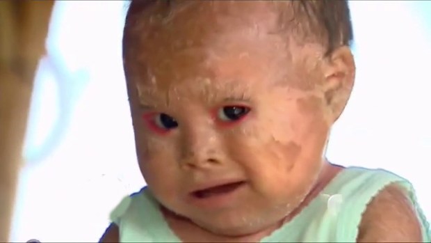 Video: Niña con piel de pescado