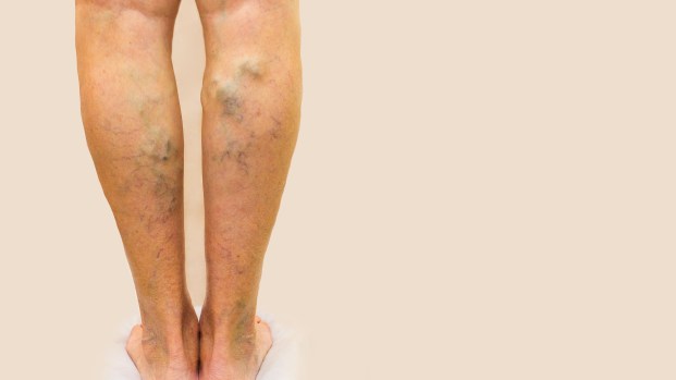 Nuevo tratamiento sin dolor contra las venas varicosas